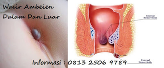 Illustration for article titled cara mengobati ambeien secara herbal